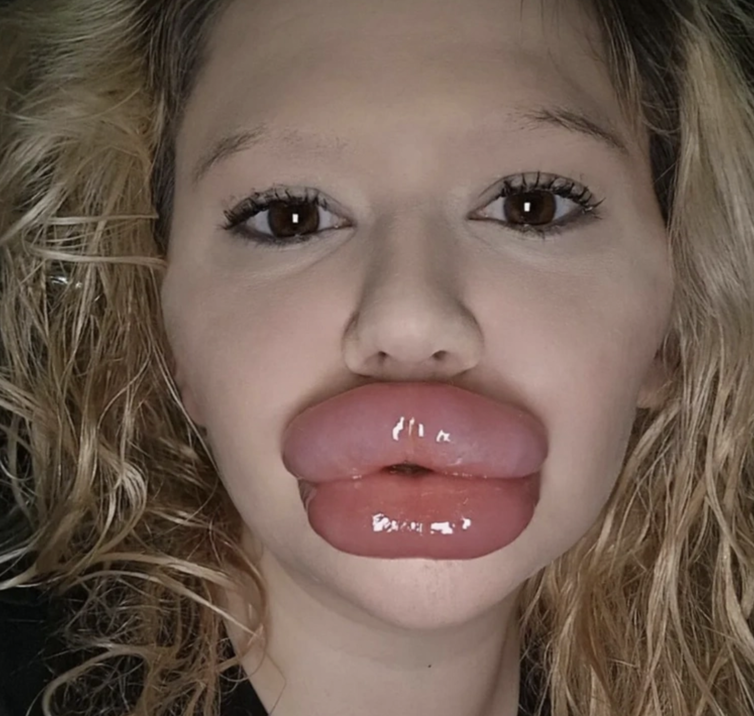 Dünya rekoru: 32 ameliyat sonucunda dünyanın en büyük dudaklarına sahip oldu