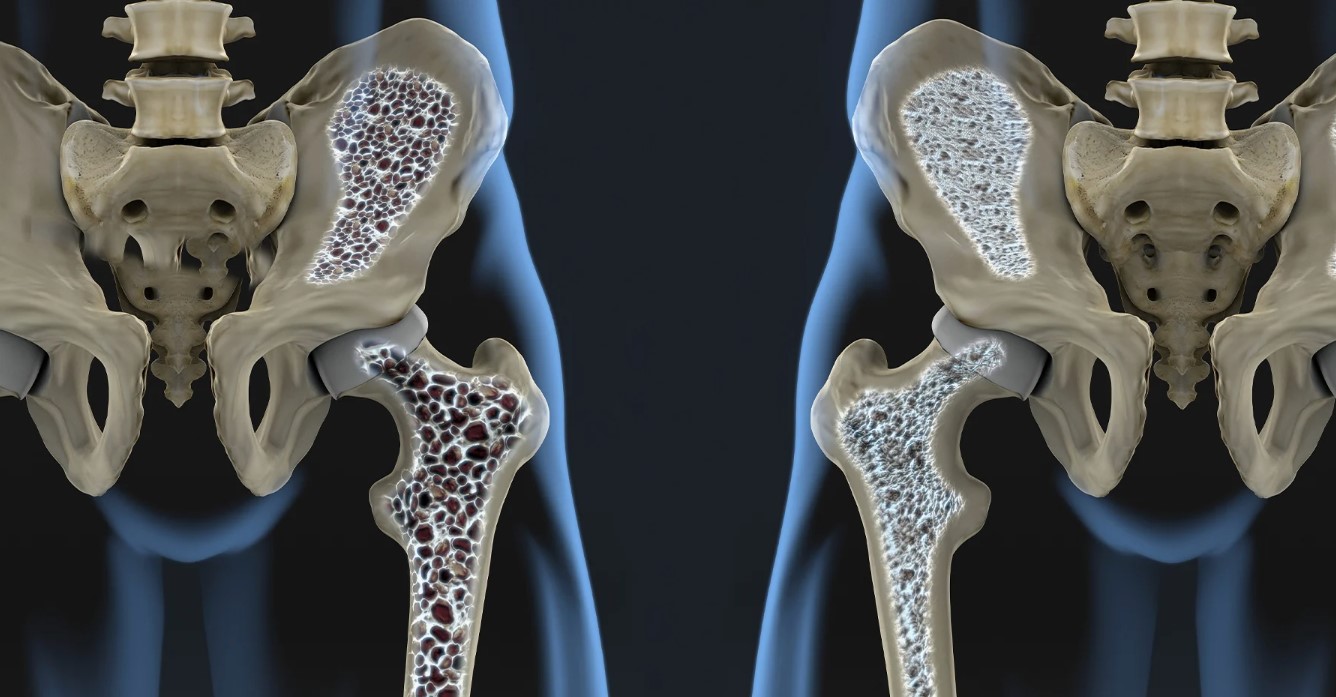 Osteoporoz Sessiz İlerliyor: Osteoporoz Nedir?