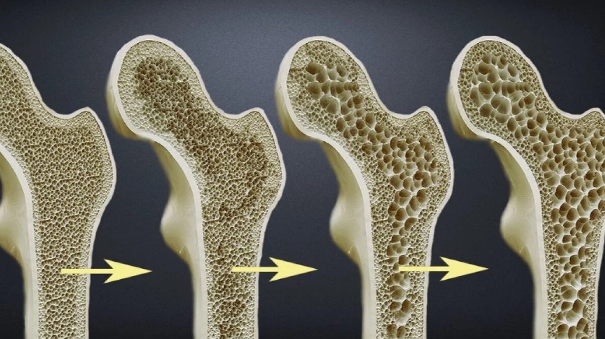 Osteoporoz Sessiz İlerliyor: Osteoporoz Nedir?