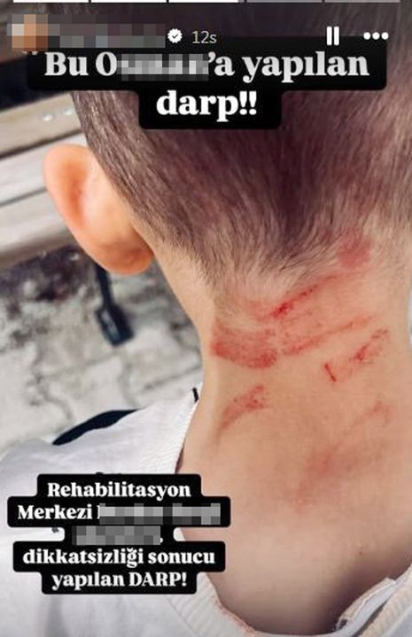Burdur'da 5 Yaşındaki Çocuğa Rehabilitasyon Merkezinde Darp İddiası 2