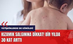 Kızamık salgınına dikkat! Bir yılda 30 kat arttı