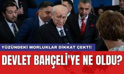 Yüzündeki morluklar dikkat çekti! Devlet Bahçeli'ye ne oldu?