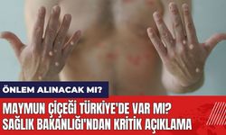 Maymun Çiçeği Türkiye'de var mı? Sağlık Bakanlığı'ndan kritik açıklama