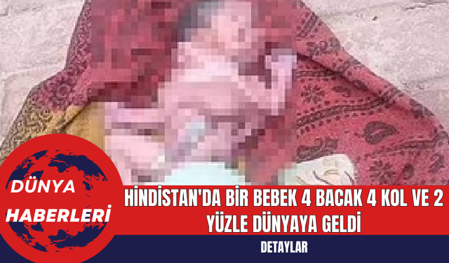 Hindistan'da Bir Bebek 4 Bacak 4 Kol ve 2 Yüzle Dünyaya Geldi