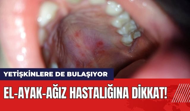 El-Ayak-Ağız Hastalığına Dikkat! Yetişkinlere de Bulaşıyor