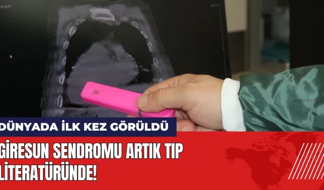 Dünyada ilk kez görüldü: Giresun Sendromu tıp literatüründe!